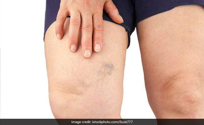 Fluid Retention