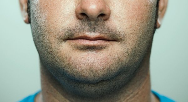 What Can Cause Weight Gain in Your Face