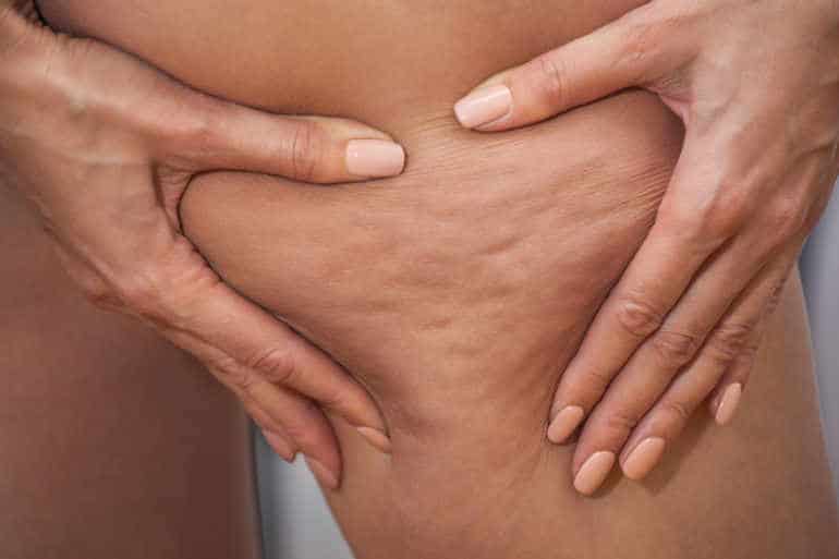 You may be frustrated and wondering how to get rid of cellulite .